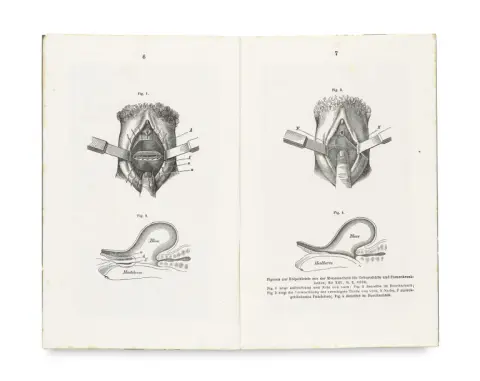 Gustav Simon – Historique sur la fermeture opératoire du vagin par réunion des parois vaginales (colpocleisis) pour…