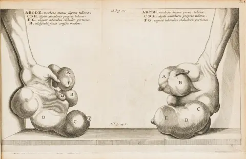 Medicin – Severino, Marco Aurelio. De abscessuum recondita natura. Libri VIII. Editio novissima. Med stukket frontispice, stukket portræt…