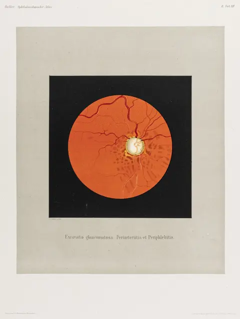 Medicin - Oftalmologi – Oeller, Johann Nepomuk. Atlas der Ophthalmoskopie. Atlas of Ophthalmoscopy. 5 leveringer i 5 mapper. Med…