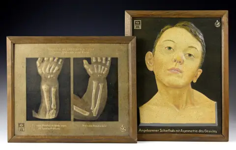Medicin og apotek – To anatomiske undervisningstavler fra Deutsches Hygienemuseum. Dresden, omkring 1930. Medfødt torticollis og lupus,…